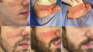 Episode 5: Scar Treatment - الحلقه الخامسة: علاج اثار الجروح و الندبات