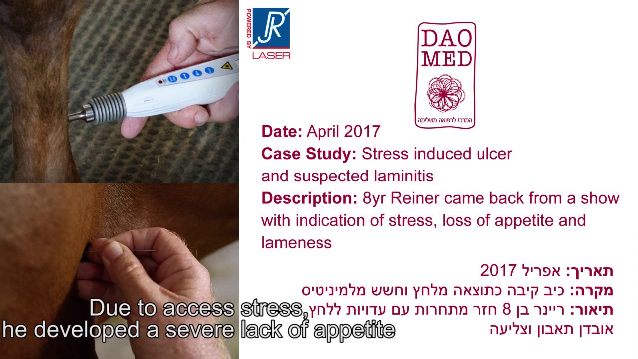 RJ Laser and Acupuncture combination treatment for stomach ulcer and