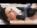 This Is Microneedling for Acne Scarring 🎯