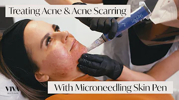 How long does microneedling last for acne scars?