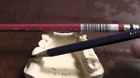 R P D Design - Ken Class IV Mand Cast #36 Part A