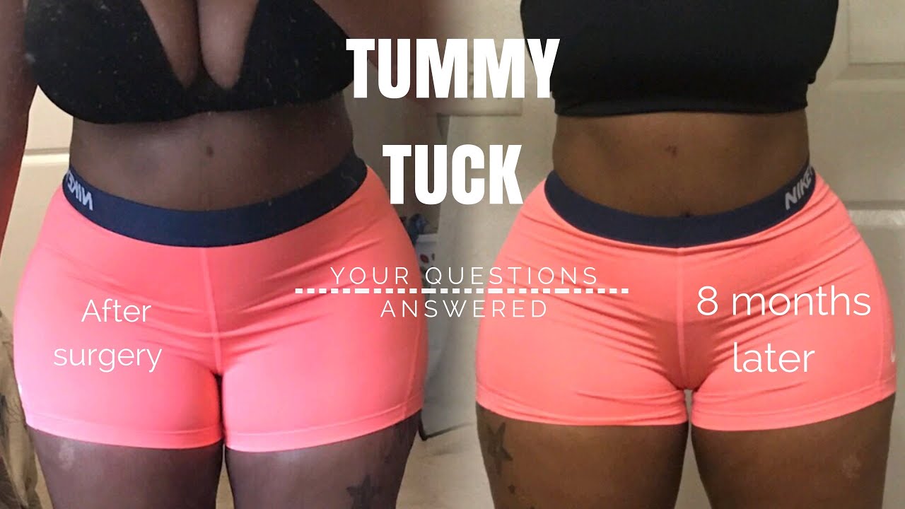 Tummy Tuck surgery before and after | 8 Months post op | Top 5 questions answered
