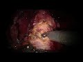 Robotic Assisted Laparoscopic Radical Prostatectomy | Brigham and Women's Hospital