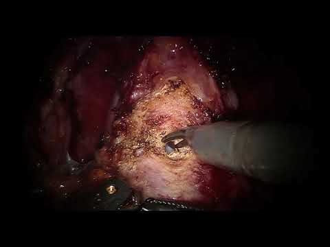 Video: Cancer De Prostată (adenocarcinom) La Câini