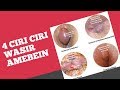 Ciri Ciri terkena penyakit wasir #Ambeien1