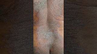 Derobin Ointment Uses in Hindi | Psoriasis की खुजली और पपड़ी की दवा | Derobin Ointment Review