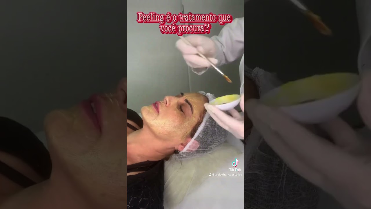 Peeling Facial em Santo André‑SP | Greicy França Estética