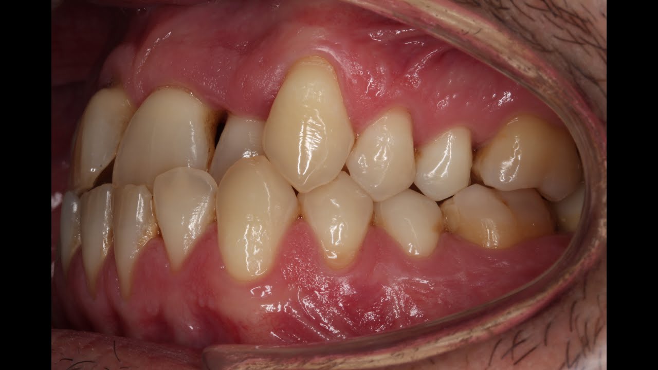 Dientes inferiores por delante de los superiores: Clase III, Prognacia