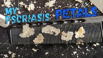 Hugely satisfying itchy DRY scalp scratching! Puff pastry skin!