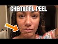 My Chemical Peel Experience on sensitive and brown skin 🖤