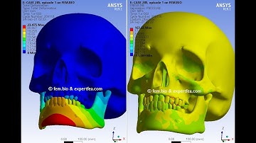Simulation of an improper teeth alignment or misaligned bite - ANSYS Workbench Explicit Dynamics