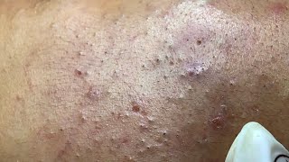 The best acne squeezing collection form Linh Mun Spa part 14
