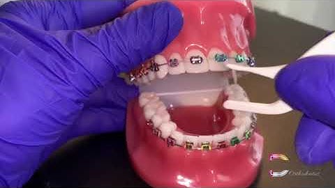 Flossing with Braces: Platypus Threader - Dougherty Orthodontics (St. Louis, Missouri)