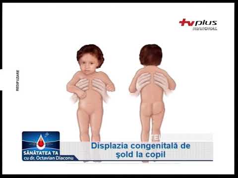 Video: Footfoot La Copii - Tratament, Masaj, Semne De Footfoot Congenital