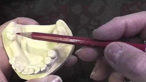 R P D Design - Ken Class III Mand Cast 2 3 3 Part A