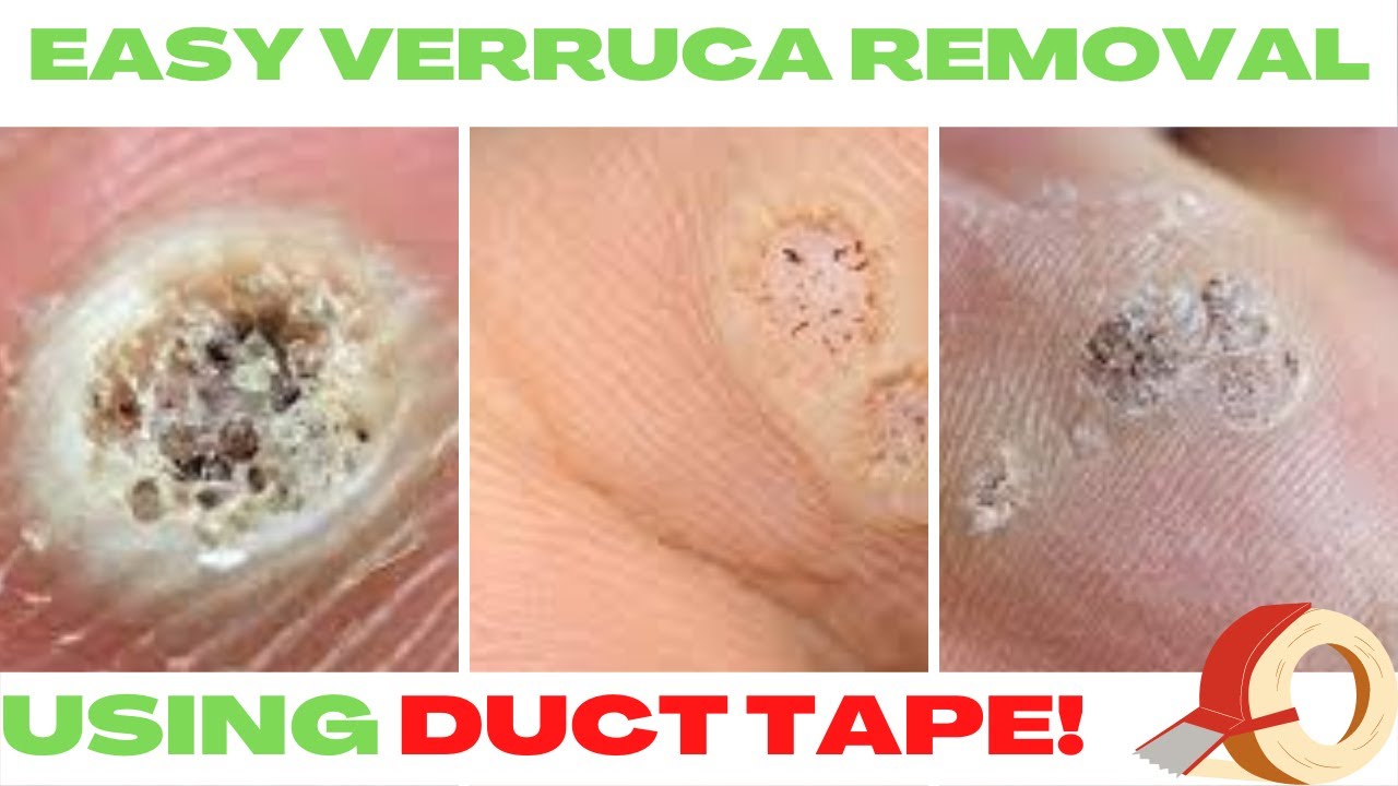 SUPER Easy Verruca Duct Tape Removal Method