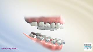 Anterior Crossbite RPE Correction