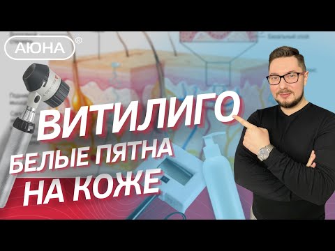 Витилиго: причины, диагностика и лечение