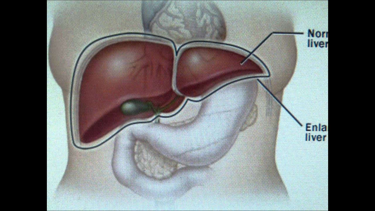 Повышенная печень что означает. Гепатомегалия.