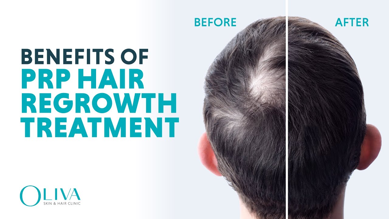Top 5 Reasons To Choose PRP Hair Loss Treatment - YouTube