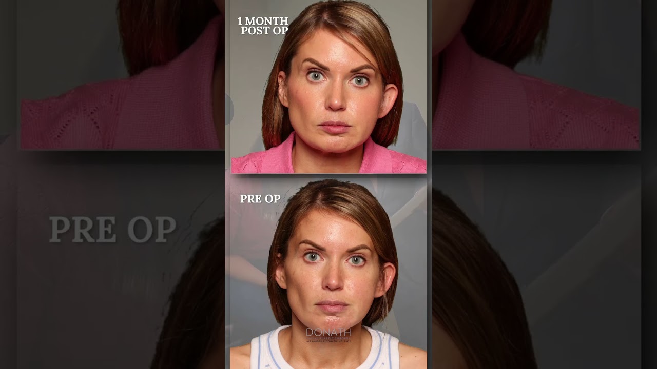 1 Month Post-Op Reveal | Fat Transfer + PRP for Facial Symmetry