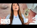 "The Award For The Biggest Blackhead" & A Juicy Cyst | Dr. Pimple Popper: This is Zit