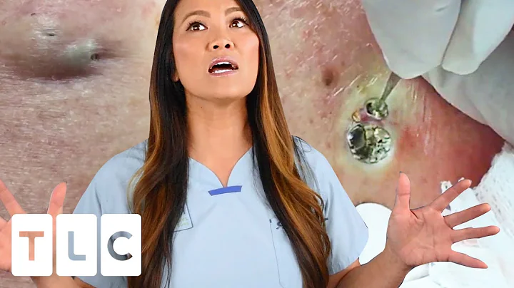 "The Award For The Biggest Blackhead" & A Juicy Cy...