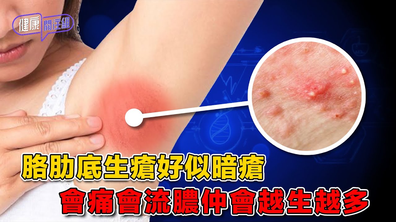 胳肋底生瘡好似暗瘡 會痛會流膿仲會越生越多 ｜ 健康關注組 ｜ EP511 ｜ 化膿性汗腺炎 ｜ 皮膚病 ｜ 暗瘡 ｜ 吳雲甫 ｜ 黃芳雯 ...