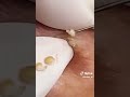 Satisfying White Pimple Removal: Precision Techniques for Flawless Skin