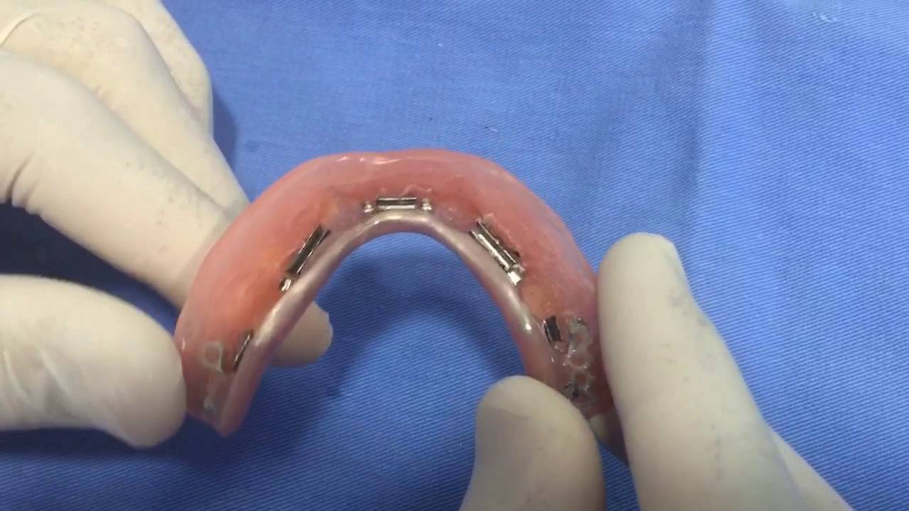 Zbogom klasičnoj protezi - Proteza na kopčanje