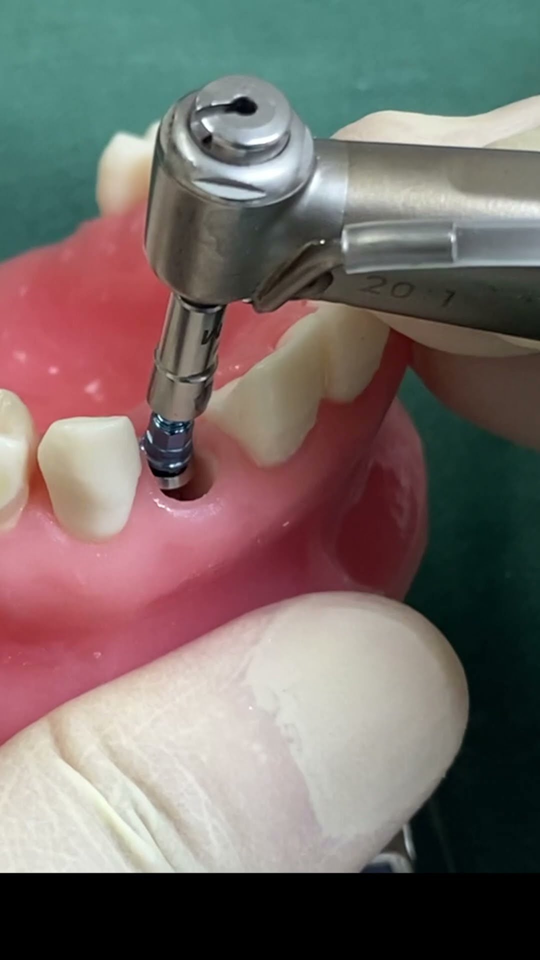 無歯顎多数歯欠損患者へのティッシュレベルインプラントを使用した安全な即時荷重治療