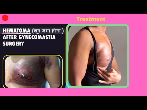 Hematoma After Gynecomastia treatment