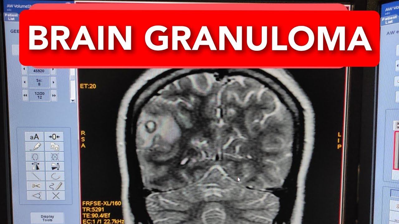 BRAIN GRANULOMA