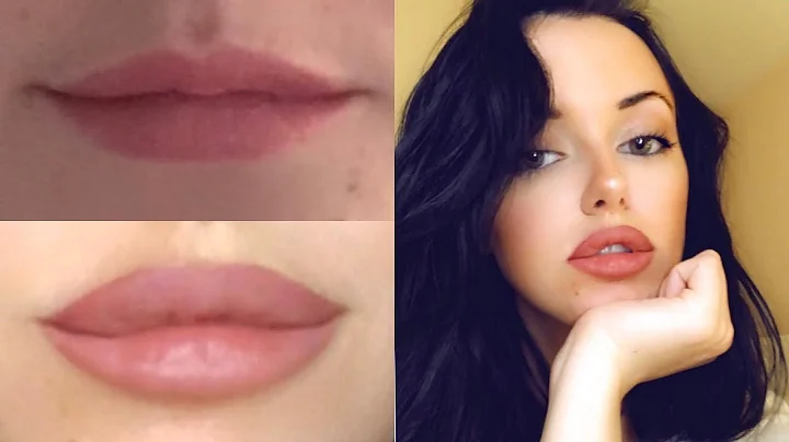 MY LIP INJECTION EXPERIENCE