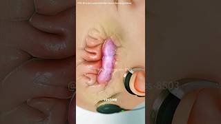Cochlear Implant surgery #3dmedicalanimation #3danimation #Cochlea #implant