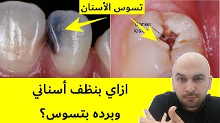 تسوس الأسنان | اسباب تسوس الاسنان رغم تنظيفها | علاج تسوس الاسنان