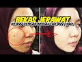 Hilangkan Bekas Jerawat Cepat dalam 1 Hari: Rahasia Kulit Mulus Tanpa Noda