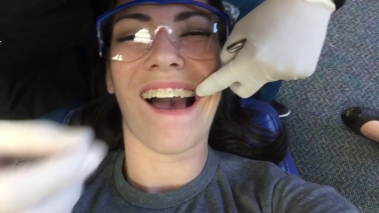 Adult Braces 6 Month Update and Final Wire YouTube