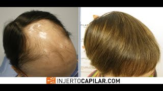 6609 FU's. Hair Transplant by FUE Technique. Radioterapia. Injertocapilar.com. 119/2008