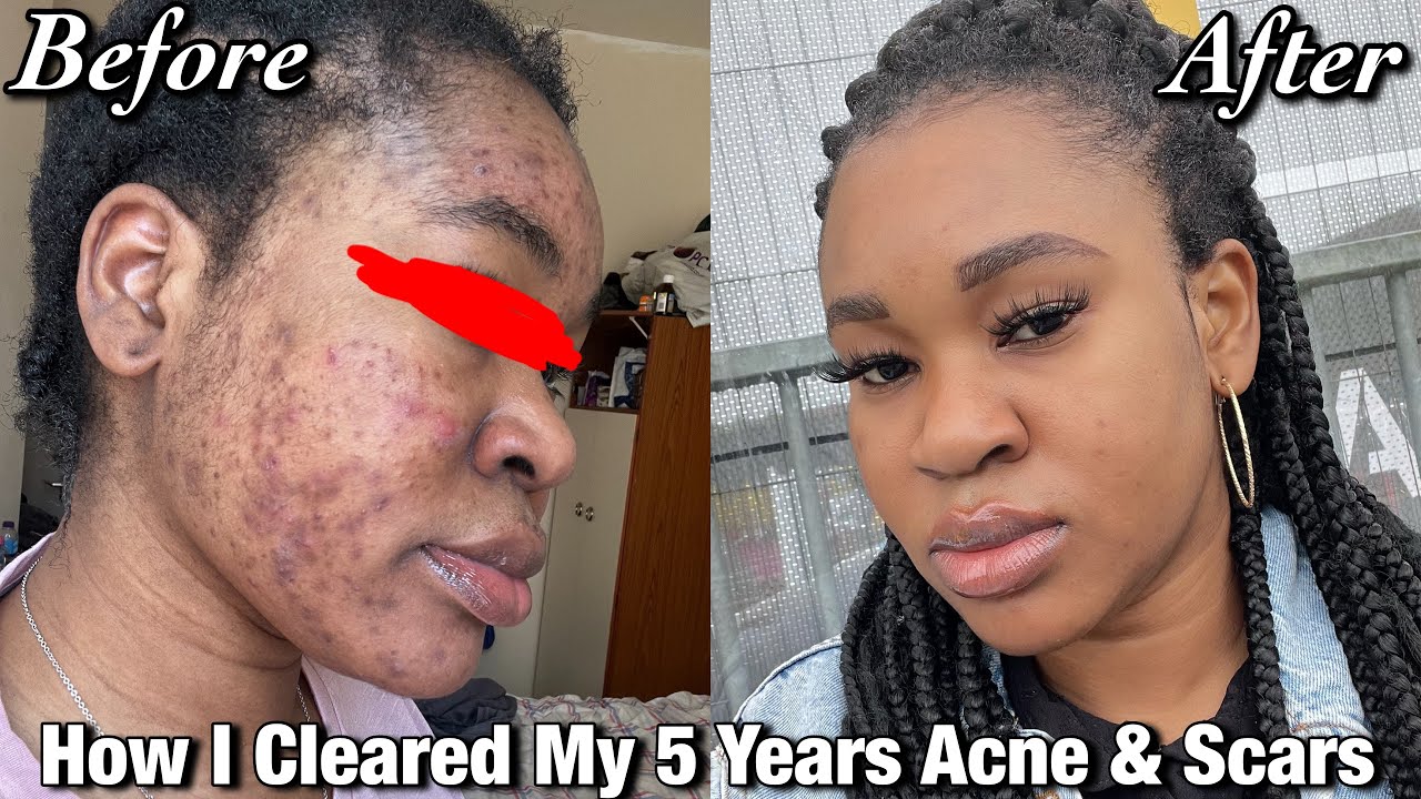 How I finally cleared my 5 Years Acne and Dark Spots | HOW I CLEARED MY ...