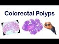 Colorectal Polyps| USMLE STEP, NCLEX, COMLEX