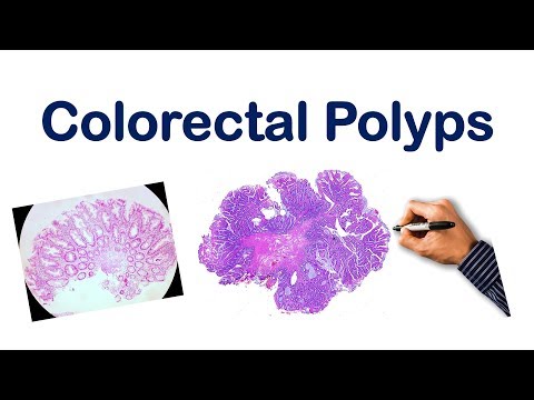 Video: Sessile Polyp: Typen, Risico Op Kanker, Follow-up En Meer