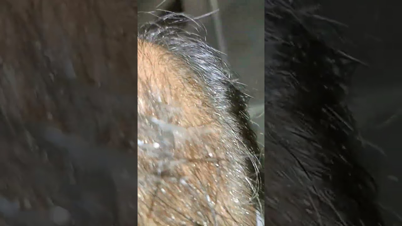 minoxidil finastrade result review day8 