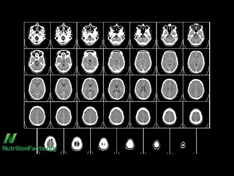 Preventing Brain Loss with B Vitamins?