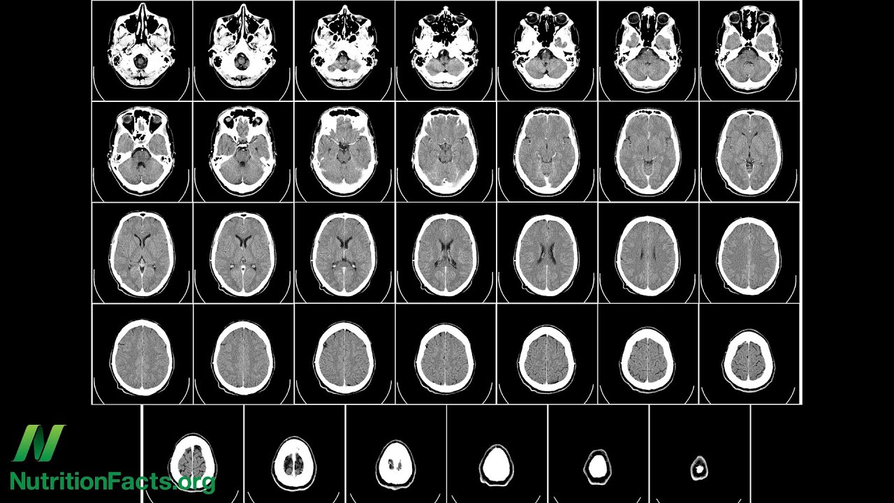 Preventing Brain Loss with Vitamins B6 B12 and Folate