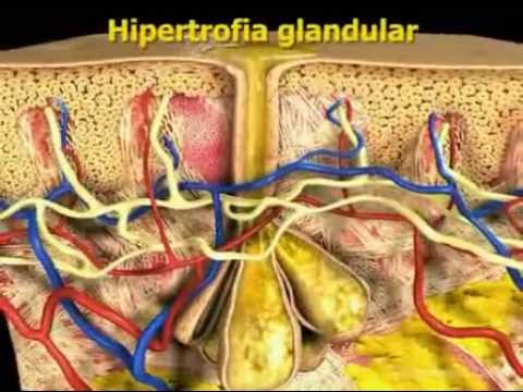 Акне вульгарис