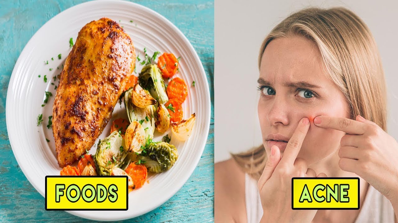 what food is linked to acne