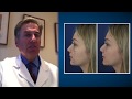 Chin Augmentation Using Patient’s Own Fat —Video Discussion by Bernard Markowitz, MD