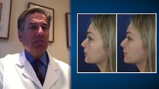 Chin Augmentation Using Patient’s Own Fat —Video Discussion by Bernard Markowitz, MD