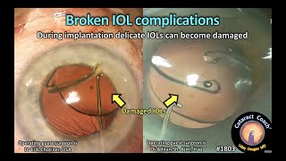 CataractCoach™1803: broken IOL complications in cataract surgery